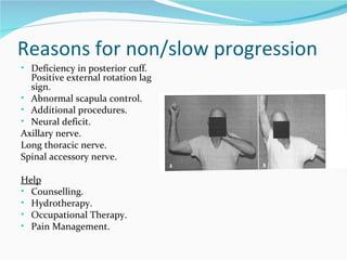 Rehabilitation following a reversed total shoulder arthroplasty nwulg ...