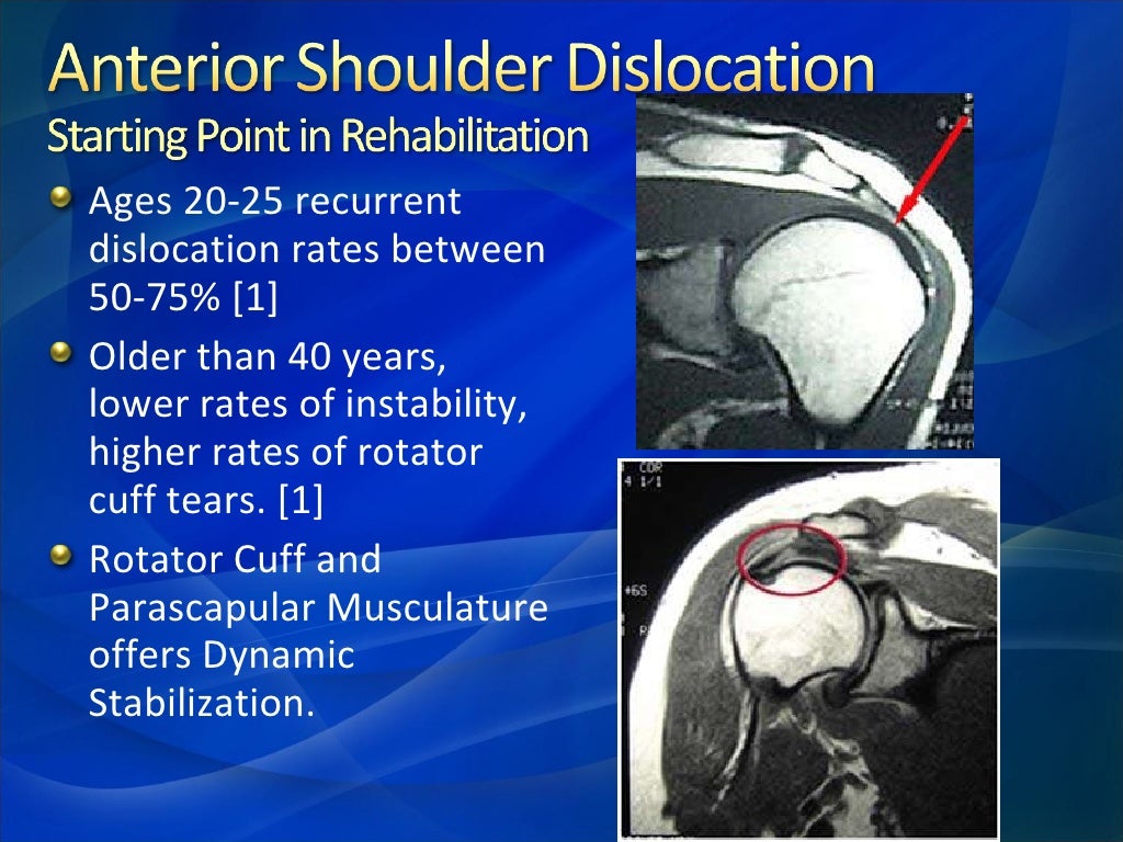 Rehabilitation Of Anterior Shoulder Dislocation