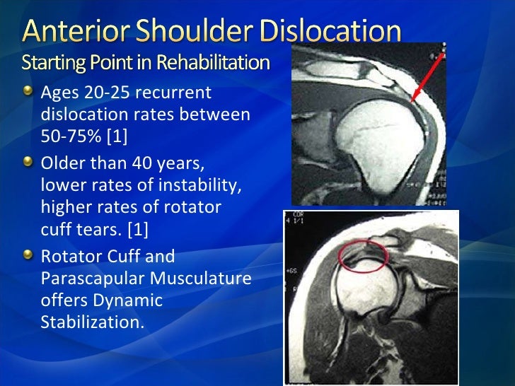 Rehabilitation Of Anterior Shoulder Dislocation