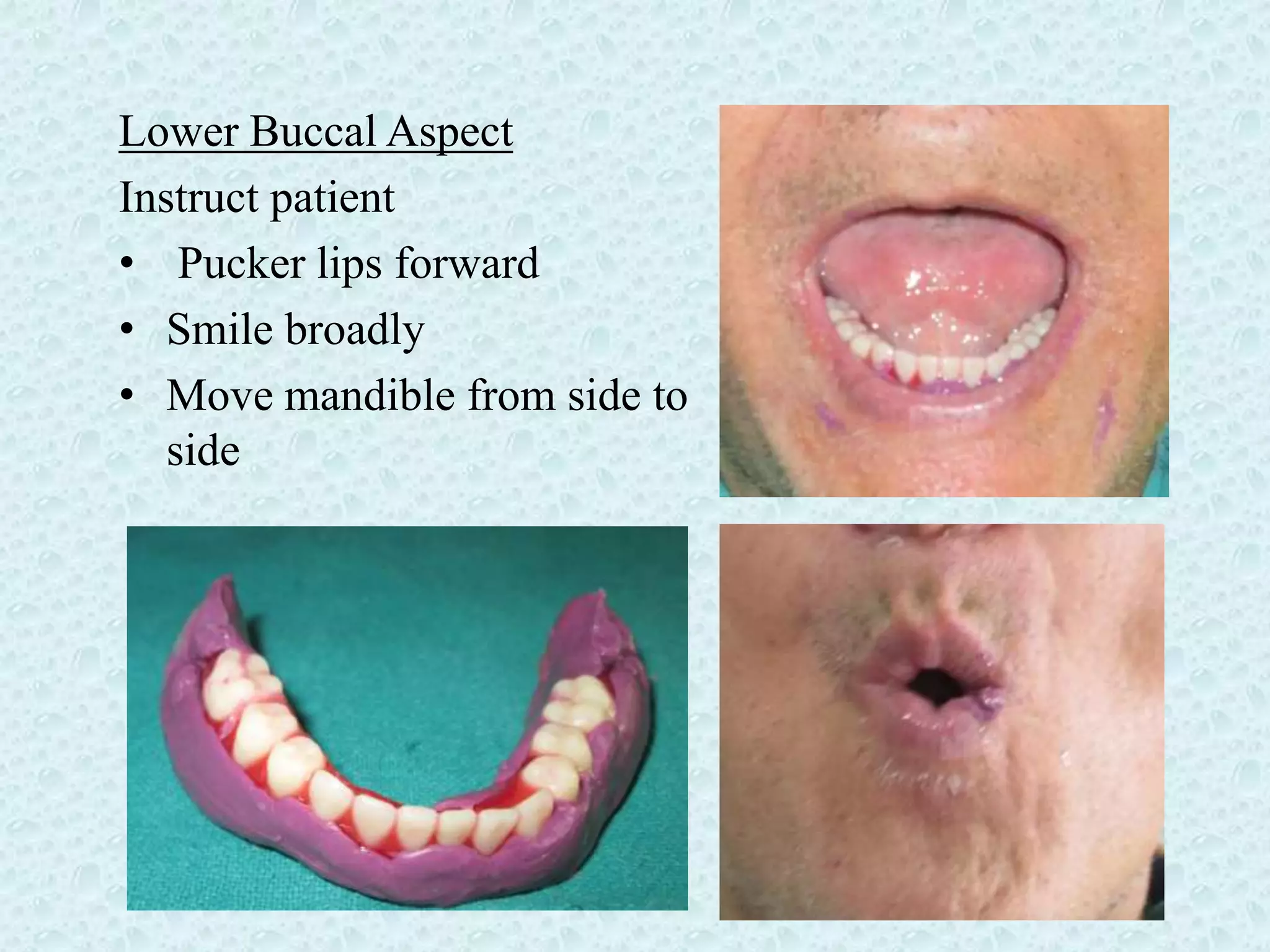 Rehabilitation of a patient with severely resorbed mandibularfinal | PPTX