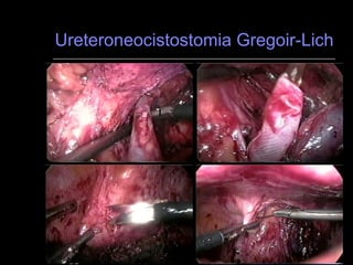 Ureteroneocistostomia Gregoir-Lich 1 2 3 4 