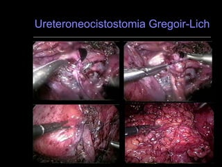 Ureteroneocistostomia Gregoir-Lich 5 6 7 8 