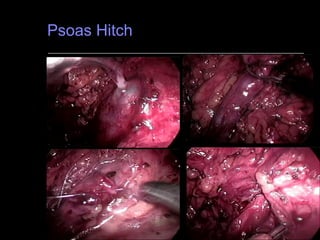 Psoas Hitch 