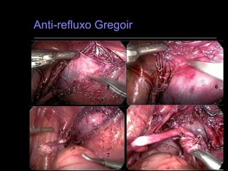 Anti-refluxo Gregoir 5 6 7 8 