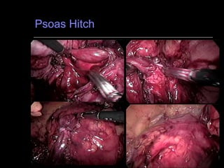 Psoas Hitch  