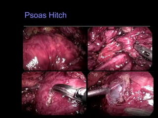 Psoas Hitch  