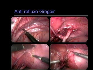 Anti-refluxo Gregoir 1 2 3 4 