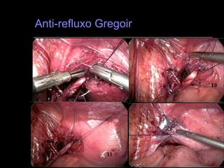 Anti-refluxo Gregoir 9 10 11 12 