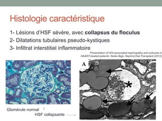 Histologie caractéristique
1- Lésions d’HSF sévère, avec collapsus du floculus
2- Dilatations tubulaires pseudo-kystiques
3- Infiltrat interstitiel inflammatoire
Presentation of HIV-associated nephropathy and outcome in
HAART-treated patients. Naïke Bigé, Nephrol Dial Transplant (2012)
Glomérule normal
HSF collapsante
 