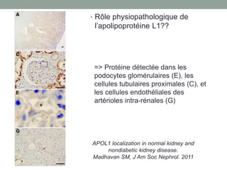 • Rôle physiopathologique de
l’apolipoprotéine L1??
=> Protéine détectée dans les
podocytes glomérulaires (E), les
cellules tubulaires proximales (C), et
les cellules endothéliales des
artérioles intra-rénales (G)
APOL1 localization in normal kidney and
nondiabetic kidney disease.
Madhavan SM, J Am Soc Nephrol. 2011
 