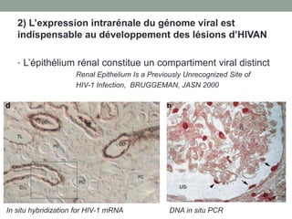 2) L’expression intrarénale du génome viral est
indispensable au développement des lésions d’HIVAN
• L’épithélium rénal constitue un compartiment viral distinct
Renal Epithelium Is a Previously Unrecognized Site of
HIV-1 Infection, BRUGGEMAN, JASN 2000
DNA in situ PCRIn situ hybridization for HIV-1 mRNA
 
