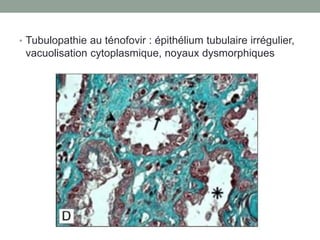 • Tubulopathie au ténofovir : épithélium tubulaire irrégulier,
vacuolisation cytoplasmique, noyaux dysmorphiques
 