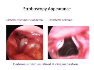 Stroboscopy Appearance
Bilateral asymmetric oedema Unilateral oedema
Oedema is best visualized during inspiration
 