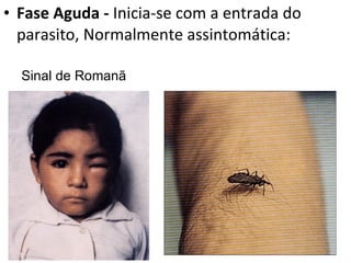 Fase Aguda -  Inicia-se com a entrada do parasito, Normalmente assintomática: Sinal de Romanã  