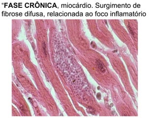 “ FASE CRÔNICA , miocárdio. Surgimento de fibrose difusa, relacionada ao foco inflamatório   