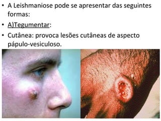 A Leishmaniose pode se apresentar das seguintes formas: A)Tegumentar :  Cutânea: provoca lesões cutâneas de aspecto pápulo-vesiculoso. 