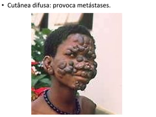 Cutânea difusa: provoca metástases. 