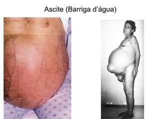 Ascite (Barriga d’água) 