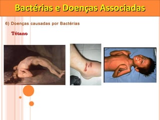 Bactérias e Doenças Associadas
6) Doenças causadas por Bactérias

  Tétano
 