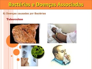 Bactérias e Doenças Associadas
6) Doenças causadas por Bactérias

  Tuberculose
 