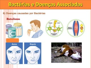 Bactérias e Doenças Associadas
6) Doenças causadas por Bactérias

  Botulismo
 