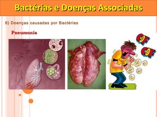 Bactérias e Doenças Associadas
6) Doenças causadas por Bactérias

  Pneumonia
 
