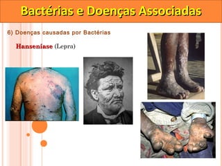 Bactérias e Doenças Associadas
6) Doenças causadas por Bactérias

  Hanseníase (Lepra)
 
