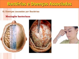 Bactérias e Doenças Associadas
6) Doenças causadas por Bactérias

  Meningite bacteriana
 