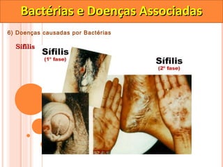 Bactérias e Doenças Associadas
6) Doenças causadas por Bactérias

  Sífilis
 