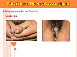Bactérias e Doenças Associadas
6) Doenças causadas por Bactérias

  Gonorréia
 