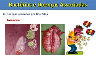 6) Doenças causadas por Bactérias
PneumoniaPneumonia
Bactérias e Doenças AssociadasBactérias e Doenças Associadas
 