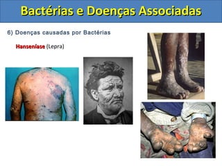 6) Doenças causadas por Bactérias
HanseníaseHanseníase (Lepra)
Bactérias e Doenças AssociadasBactérias e Doenças Associadas
 