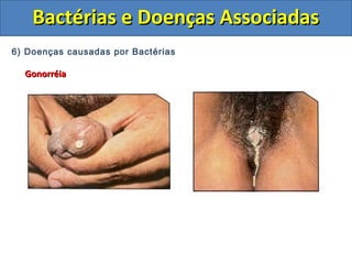 6) Doenças causadas por Bactérias
GonorréiaGonorréia
Bactérias e Doenças AssociadasBactérias e Doenças Associadas
 