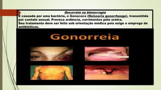 Gonorréia ou blenorragia
É causada por uma bactéria, o Gonococo (Neisseria gonorrheage), transmitida
por contato sexual. Provoca ardência, corrimentos pela uretra.
Seu tratamento deve ser feito sob orientação médica pois exige o emprego de
antibióticos.
 