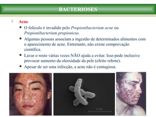  Acne
 O folículo é invadido pelo Propionibacterium acne ou
Propionibacterium propionicus.
 Algumas pessoas associam a ingestão de determinados alimentos com
o aparecimento de acne. Entretanto, não existe comprovação
científica.
 Lavar o rosto várias vezes NÃO ajuda a evitar. Isso pode inclusive
provocar aumento da oleosidade da pele (efeito rebote).
 Apesar de ser uma infecção, a acne não é contagiosa.
BACTERIOSES
 