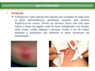  Furúnculo
 O furúnculo é uma infecção dos folículos das cavidades de onde saem
os pelos (pilossebáceos), geralmente causados pela bactéria
Staphylococcus aureus. Ocorre em diversos locais, mas está mais
sujeito a surgir em regiões onde há maior transpiração e/ou fricção,
como axilas, virilha, nádegas e pescoço. Assim, o uso de roupas
apertadas e substâncias que obstruem os poros favorecem sua
manifestação.
BACTERIOSES
 