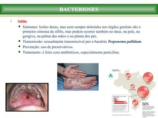  Sífilis
 Sintomas: lesões duras, mas nem sempre doloridas nos órgãos genitais são o
primeiro sintoma da sífilis, mas podem ocorrer também no ânus, na pele, na
gengiva, na palma das mãos e na planta dos pés.
 Transmissão: sexualmente transmissível por a bactéria Treponema pallidum.
 Prevenção: uso de preservativos.
 Tratamento: é feito com antibióticos, especialmente penicilina.
BACTERIOSES
 