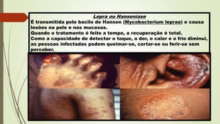 Lepra ou Hanseníase
É transmitida pelo bacilo de Hansen (Mycobacterium leprae) e causa
lesões na pele e nas mucosas.
Quando o tratamento é feito a tempo, a recuperação é total.
Como a capacidade de detectar o toque, a dor, o calor e o frio diminui,
as pessoas infectadas podem queimar-se, cortar-se ou ferir-se sem
perceber.
 