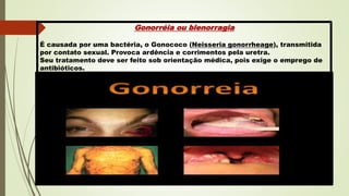 Gonorréia ou blenorragia
É causada por uma bactéria, o Gonococo (Neisseria gonorrheage), transmitida
por contato sexual. Provoca ardência e corrimentos pela uretra.
Seu tratamento deve ser feito sob orientação médica, pois exige o emprego de
antibióticos.
 