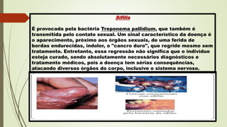 Sífilis
É provocada pela bactéria Treponema pallidium, que também é
transmitida pelo contato sexual. Um sinal característico da doença é
o aparecimento, próximo aos órgãos sexuais, de uma ferida de
bordas endurecidas, indolor, o "cancro duro", que regride mesmo sem
tratamento. Entretanto, essa regressão não significa que o indivíduo
esteja curado, sendo absolutamente necessários diagnósticos e
tratamento médicos, pois a doença tem sérias consequências,
atacando diversos órgãos do corpo, inclusive o sistema nervoso.
 