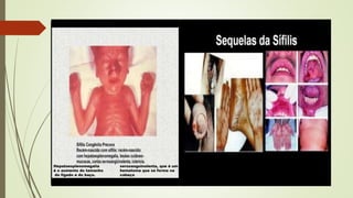 Hepatoesplenomegalia
é o aumento do tamanho
do fígado e do baço.
serosanguinolenta, que é um
hematoma que se forma na
cabeça
 