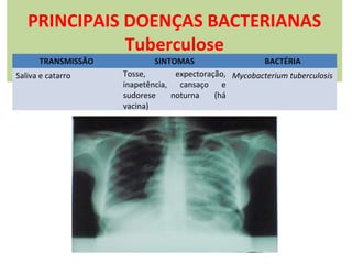 PRINCIPAIS DOENÇAS BACTERIANAS
Tuberculose
TRANSMISSÃO

Saliva e catarro

SINTOMAS
BACTÉRIA
Tosse,
expectoração, Mycobacterium tuberculosis
inapetência, cansaço e
sudorese
noturna
(há
vacina)

 