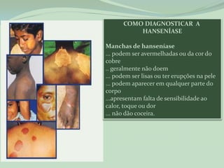 COMO DIAGNOSTICAR A
          HANSENÍASE

Manchas de hanseníase
... podem ser avermelhadas ou da cor do
cobre
.. geralmente não doem
... podem ser lisas ou ter erupções na pele
... podem aparecer em qualquer parte do
corpo
...apresentam falta de sensibilidade ao
calor, toque ou dor
... não dão coceira.
 