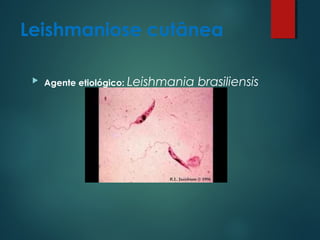 Leishmaniose cutânea
 Agente etiológico: Leishmania brasiliensis
 