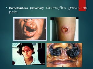  Características (sintomas): ulcerações graves na
pele.
 