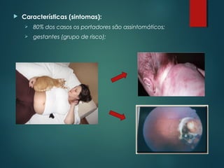  Características (sintomas):
 80% dos casos os portadores são assintomáticos;
 gestantes (grupo de risco);
 