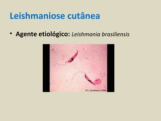 Leishmaniose cutânea
• Agente etiológico: Leishmania brasiliensis
 