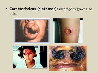 • Características (sintomas): ulcerações graves na
  pele.
 