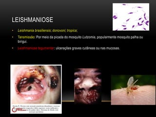 LEISHMANIOSE 
• Leishmania brasiliensis; donovoni; tropica; 
• Tansmissão: Por meio da picada do mosquito Lutzomia, popularmente mosquito palha ou 
birigui. 
• Leishmaniose tegumentar: ulcerações graves cutâneas ou nas mucosas. 
 