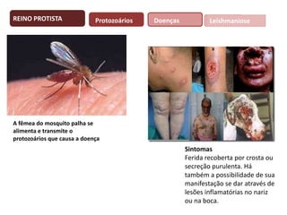 REINO PROTISTA

Protozoários

Doenças

Leishmaniose

A fêmea do mosquito palha se
alimenta e transmite o
protozoários que causa a doença

Sintomas
Ferida recoberta por crosta ou
secreção purulenta. Há
também a possibilidade de sua
manifestação se dar através de
lesões inflamatórias no nariz
ou na boca.

 